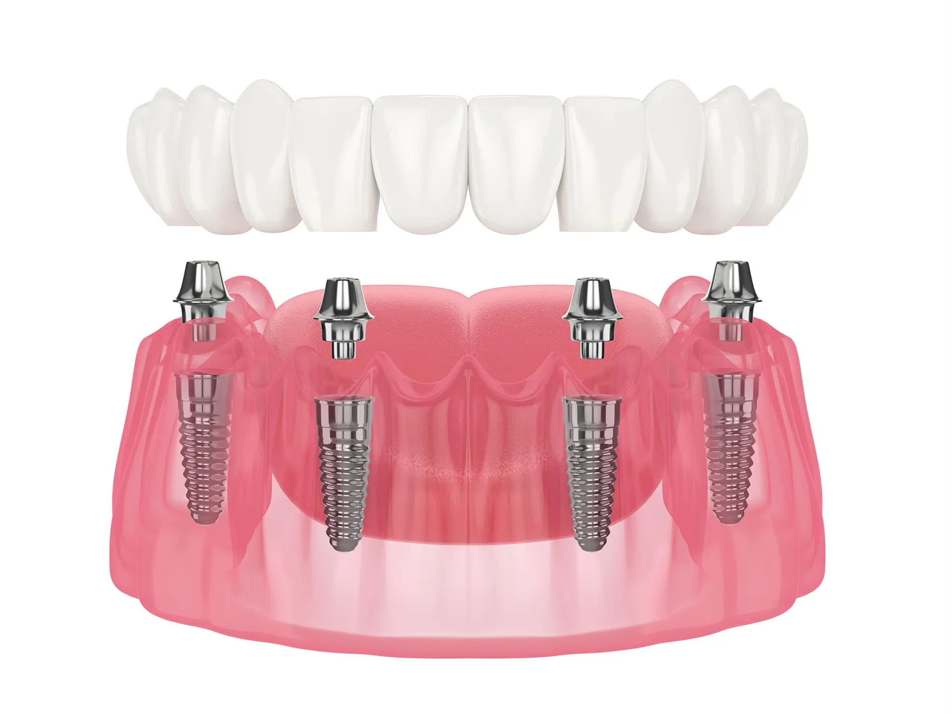 All-on-4 implants