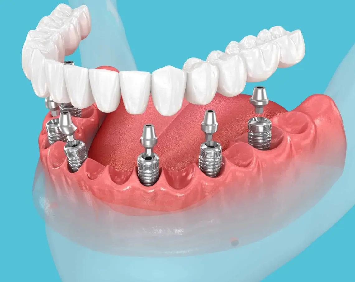 All-on-6 implants