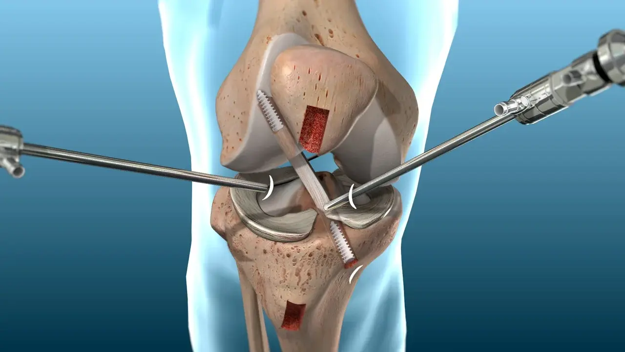Arthroscopie