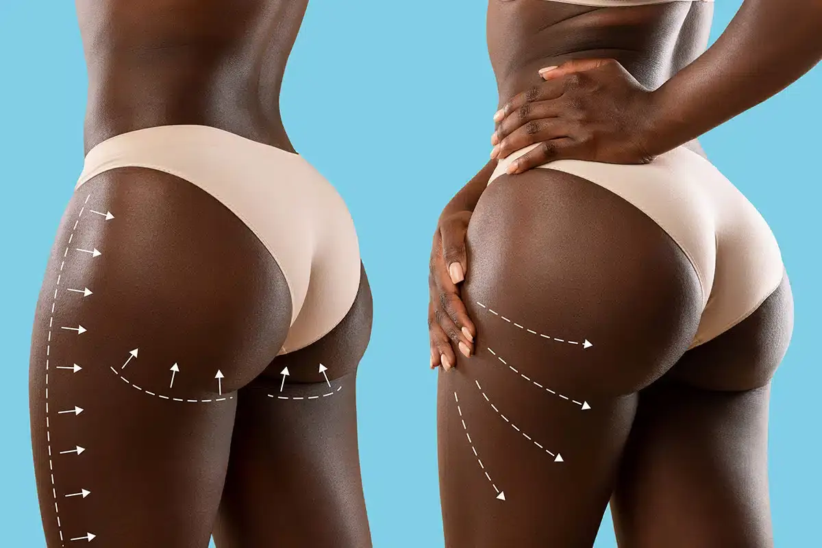Brazilian Butt Lift (BBL)