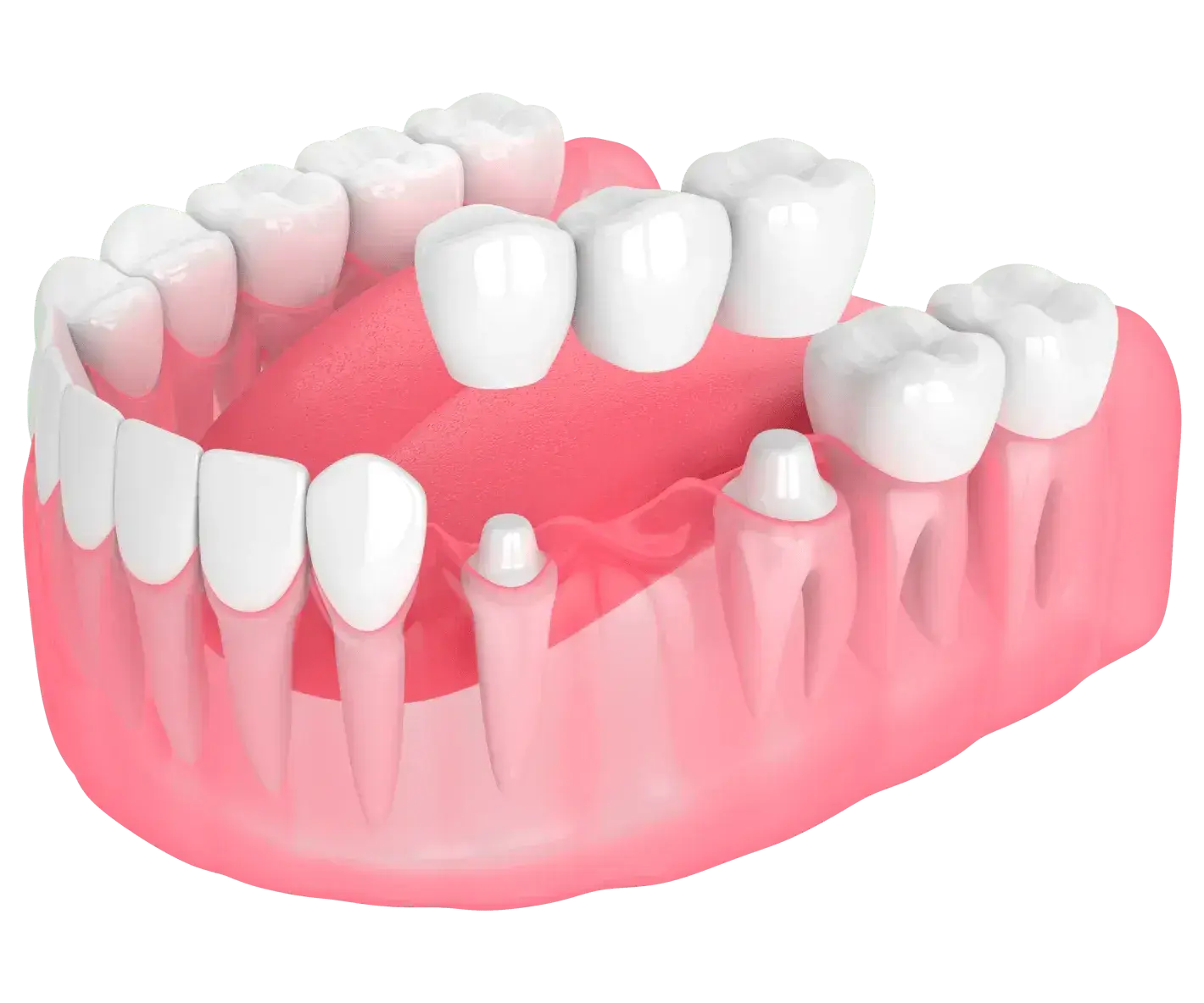 Dental bridges
