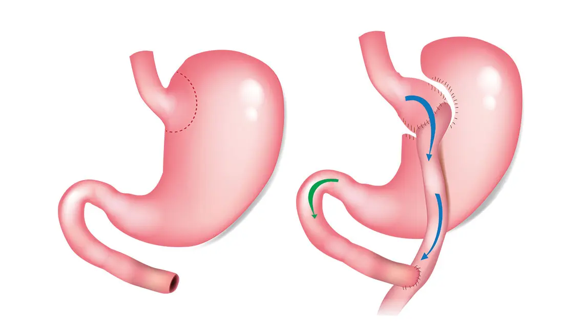 Bypass gastrique