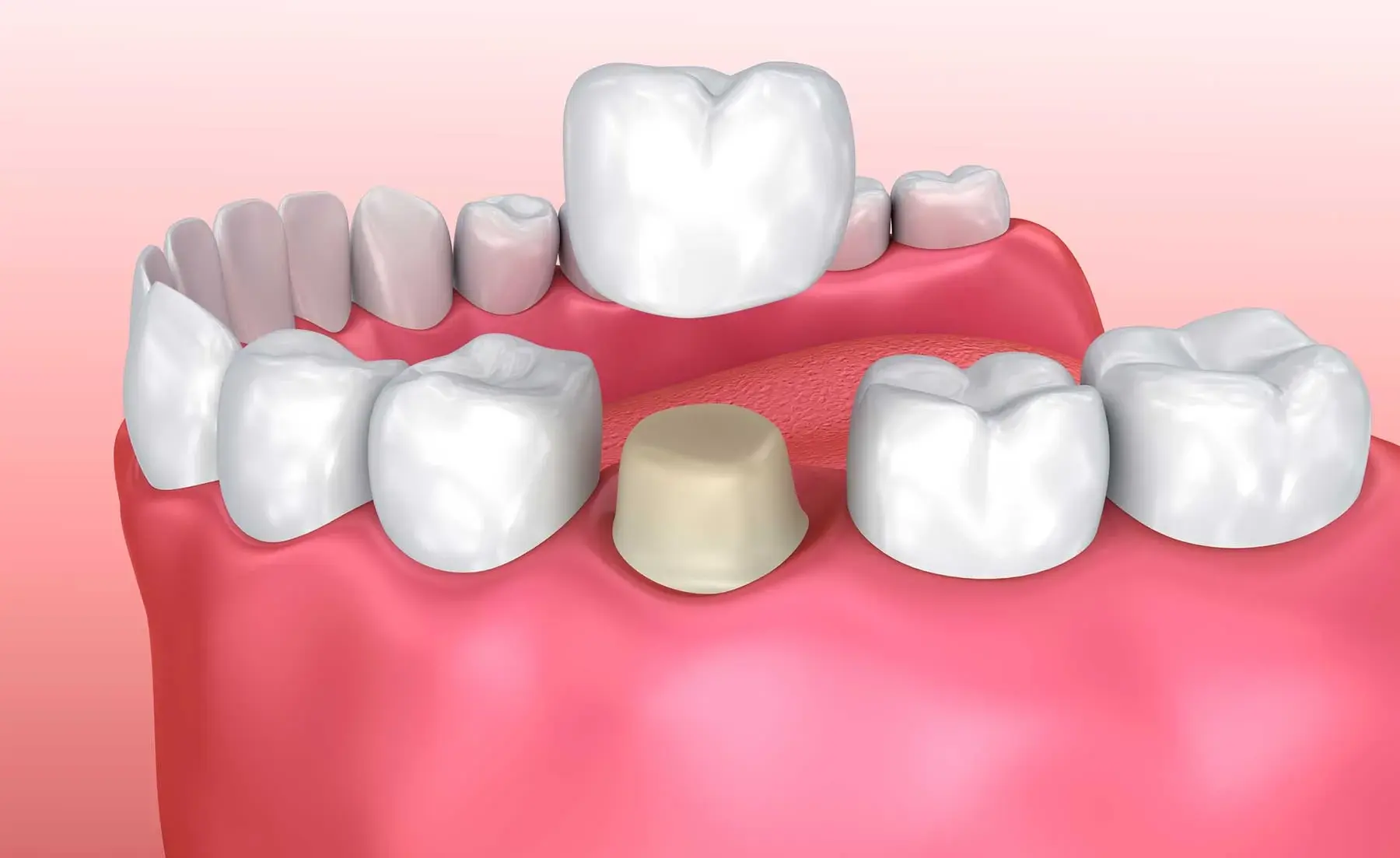 Zirconia dental crown