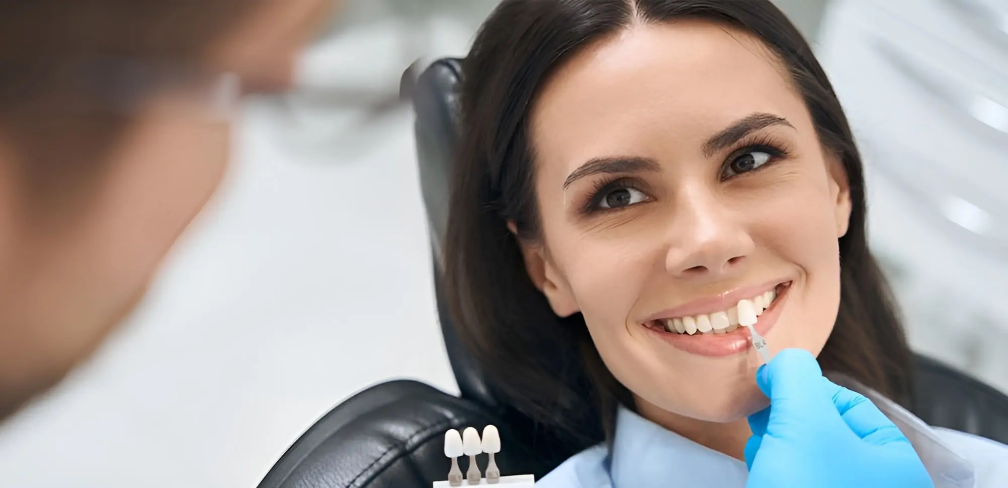 Ceramic veneers