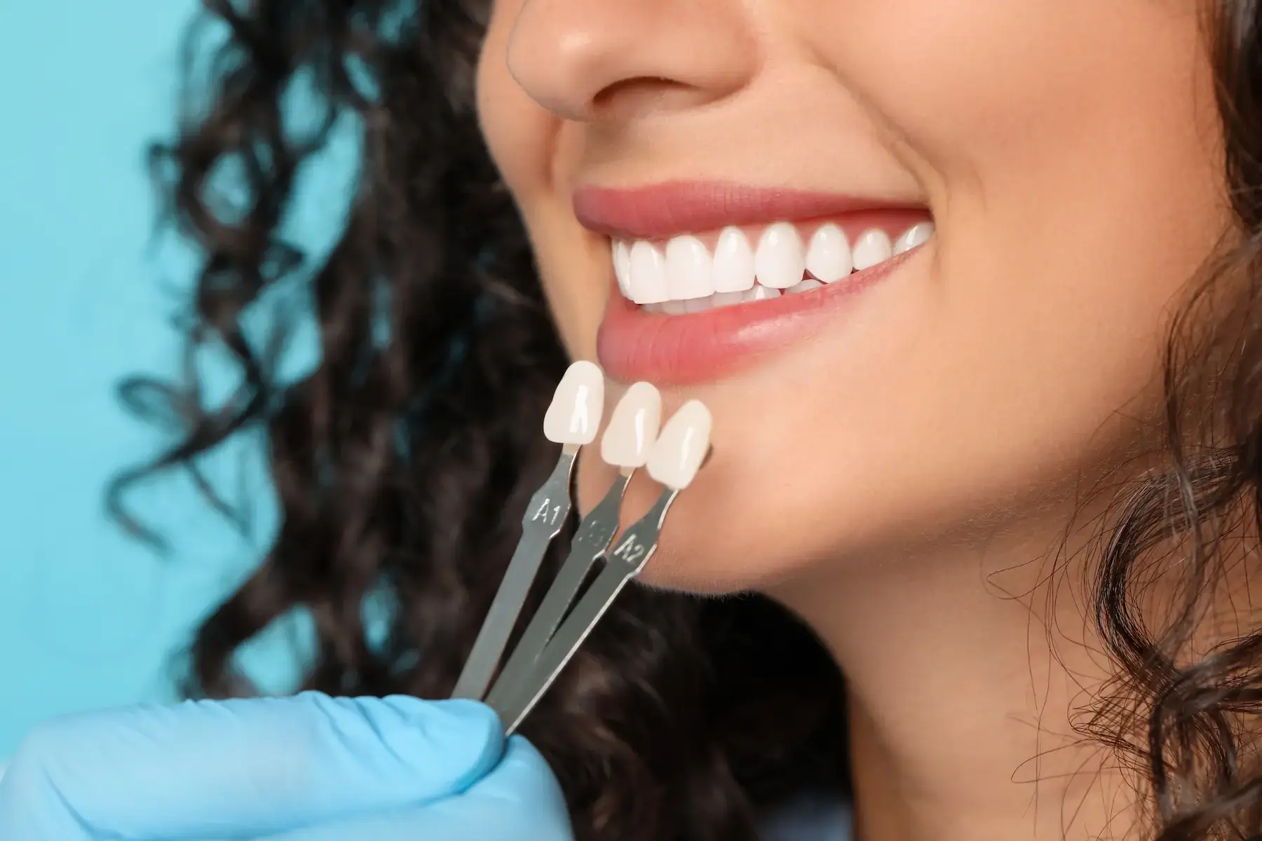 Lumineers veneers