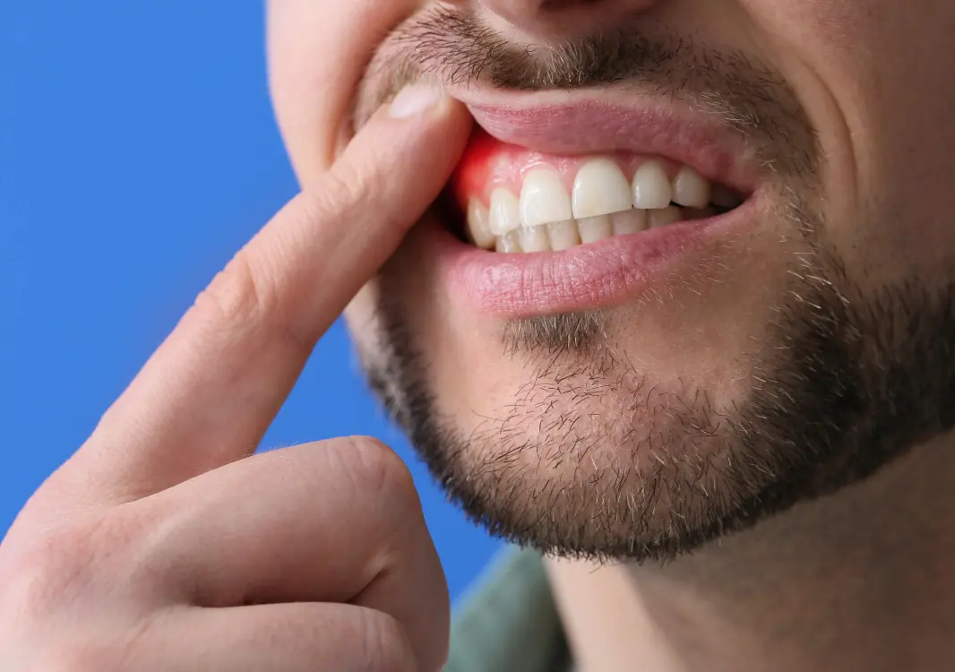 Gum contouring