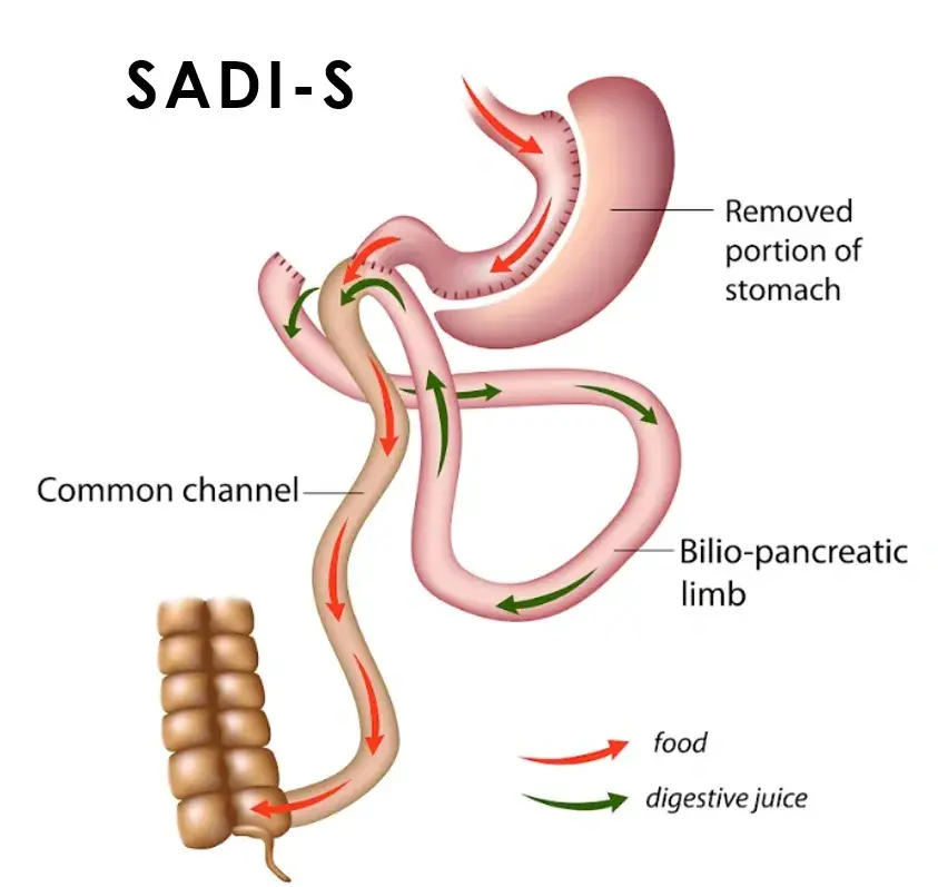 SADI-S