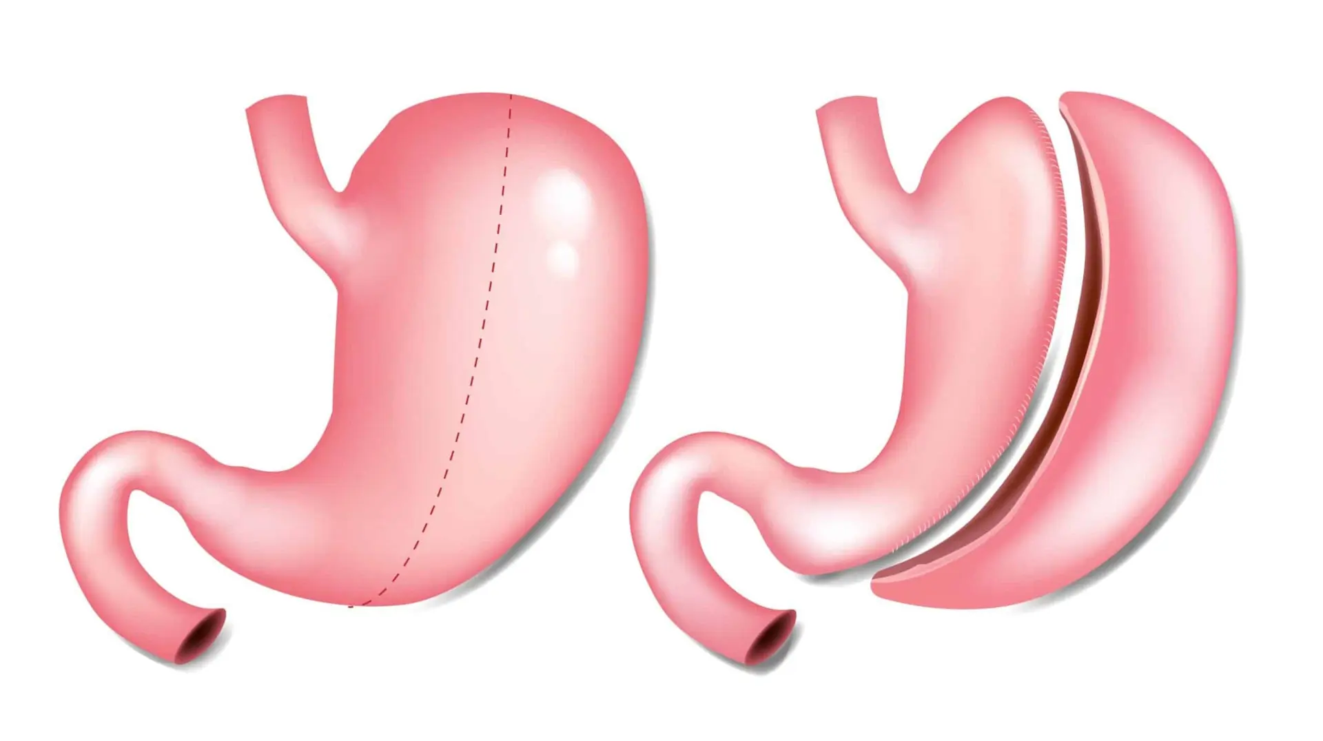 Sleeve gastrectomie